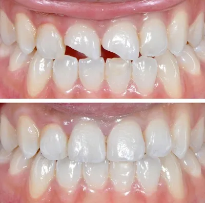 Эстетическая стоматология - художественная реставрация зубов - «Почти  четыре года после реставрации зуба - все на месте! » | отзывы