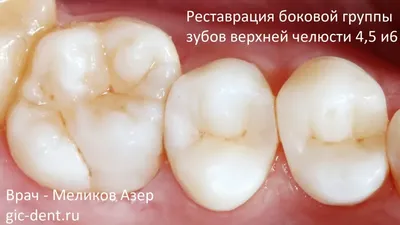 Реставрация зубов в Санкт Петербурге недорого, цены - Мастерская улыбок