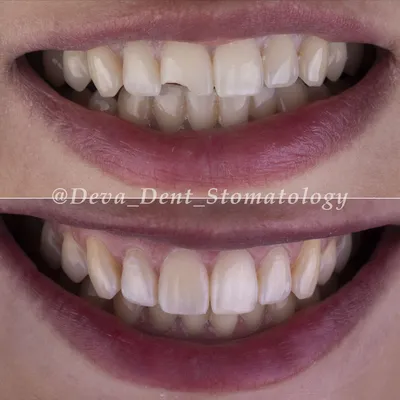 Фото художественных реставраций зубов | Фотогалерея Deva-Dent