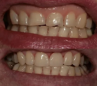 Художественная реставрация передних зубов — моделирование до и после |  Dental Art