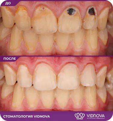 Фото до и после реставрации зубов в Волжском в клинике «ДАША»