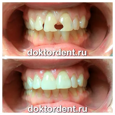 Что такое реставрация зубов
