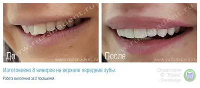 Художественная реставрация зубов - Стоматология Vidnova