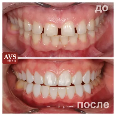 Реставрация зубов - цена на художественное восстановление зубов в СПб