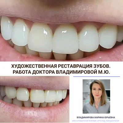 Диастема зубов - как убрать щель между зубами | SILK