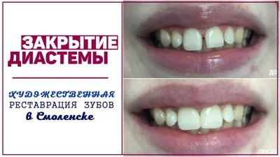 Реставрация зубов в Кирове