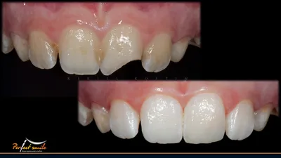 Эстетическая стоматология - художественная реставрация зубов - «Результатом  очень довольна!!! Фото до и после. Думаю о композитных винирах....» | отзывы