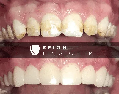 Эстетическая реставрация зубов: показания, способы, этапы | Центр  стоматологии «Ваш Стоматолог»