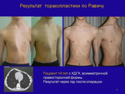 Воронкообразная деформация грудной клетки в Киеве - частная клиника Oberig.  Воронкообразная деформация грудной клетки - стоимость, отзывы в клинике  европейского уровня