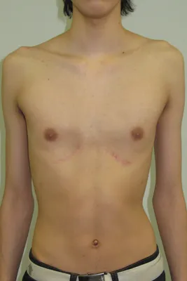 Деформация грудной клетки | Пикабу