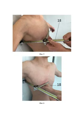 Thorax / Титульная страница / Презентация доклада: Хирургическое лечение килевидной  деформации грудной клетки