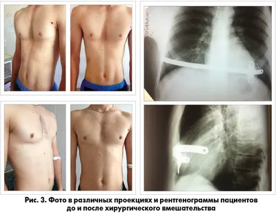 Классификация воронкообразной грудной клетки | Пластическая и торакальная  хирургия в Узбекистане