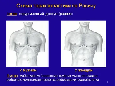 Деформация грудной клетки: причины и лечение