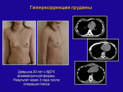 СПОСОБ ЛЕЧЕНИЯ КИЛЕВИДНОЙ ДЕФОРМАЦИИ ГРУДНОЙ КЛЕТКИ КОМПРЕССИРУЮЩИМ  ОРТЕЗОМ. Патент № RU 2725963 МПК A61F5/00 | Биржа патентов - Московский  инновационный кластер