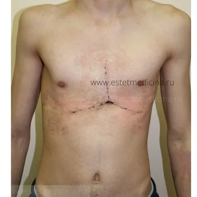 Корсет Ферре при килевидной деформации грудной клетки |  Протезно-ортопедический центр | Дзен