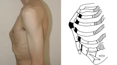 Деформация грудной клетки у детей и подростков - виды, диагностика,  лечение, операция