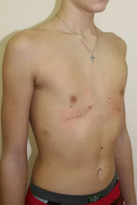 Килевидная грудная клетка: лечение - видео как проходит операция Абрамсона  по коррекции килевидной деформации