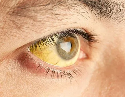 Капли для глаз Alcon Тобрадекс (TOBRADEX) - «Слабонервным лучше мимо.  Тобрадекс при лечении кисты» | отзывы