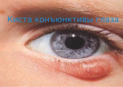 Киста конъюнктивы глаза - лечение без операции