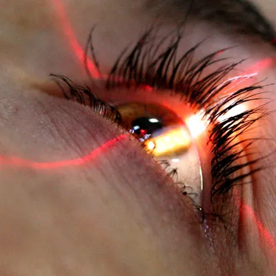 Киста конъюнктивы глаза Глаза - особо ранимая и деликатная область  организма. Одним из частых поражений-образований.. | ВКонтакте