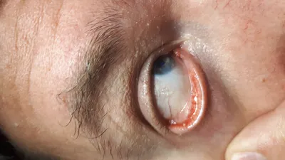 Отзыв о Операция по удалению жемчужной кисты коньюктивы глаза | Терпимо,  все-таки операция
