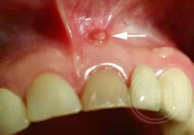 Киста после удаления зуба: кто виноват и как лечить заболевание | Dental Art
