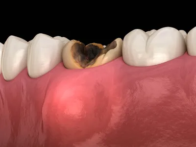 Лечение кисты зуба в Москве, описание методов и цены | «Вита-Стом»