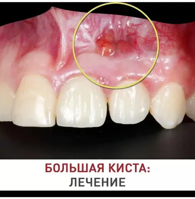 Ретенционная киста губы | Детская и семейная стоматологическая клиника  \"Белая Медведица\" | Санкт-Петербург