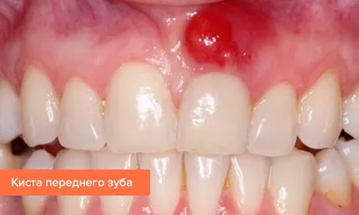 Киста зуба – чем опасна, симптомы, как выглядит