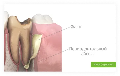 Ретенционная киста нижней губы - удаление в Киеве