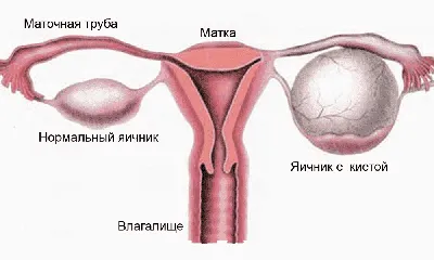 Лечение кисты зуба: симптомы, осложнения, цены, как лечить зубную кисту в  Москве