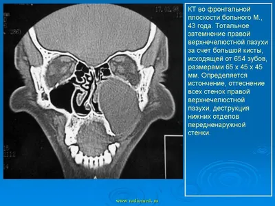 Удаление кисты зуба - стоимость услуги Резекция верхушки корня зуба в  Киеве, Удаление кисты зуба - цена в стоматологии lipinskii.com.ua