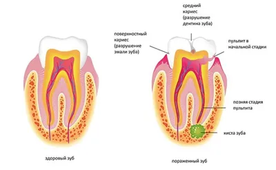 Киста зуба: лечение (удаление), причины, симптомы