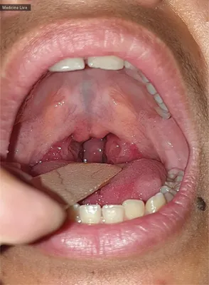 Киста зуба - описание болезни от стоматологии «Доктор Смайл»