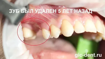 Киста корня зуба под коронкой – почему возникает патология, как ее  распознают и лечат