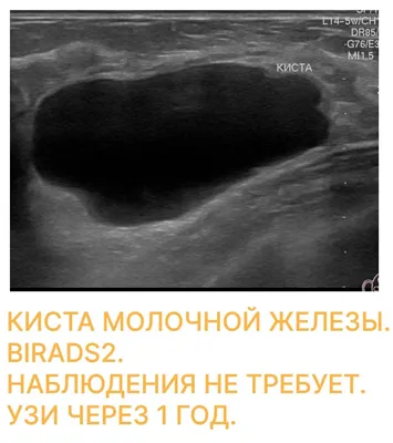 Скажите, давно у Вас находили ОБРАЗОВАНИЯ ( фиброаденома, киста, узел,  липома) на УЗИ? | Д-Клиник - Многопрофильная клиника доказательной медицины  в Лыткарино | Дзен