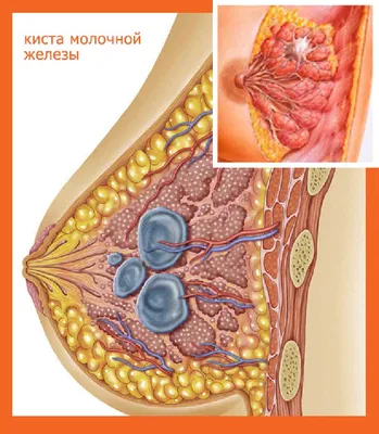 Лечение кисты молочной железы