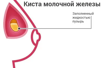 Киста молочной железы Что это, как образуется, чем лечить? | Семейная Бьюти  | Дзен