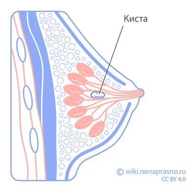 Онко Вики — Доброкачественные заболевания молочных желез