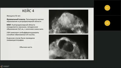 Доброкачественные изменения молочной железы округлые и овальные  образования.\" комитет МРО РОРР - YouTube