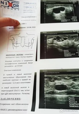 УЗИ молочных желез - Фиброаденома? - Клинический случай, Видео, Фото ::  Случаи УЗИ - Эхограммы, кинопетли, примеры из практики :: Форум - Для  врачей УЗИ :: Uzgraph.ru - мобильная версия