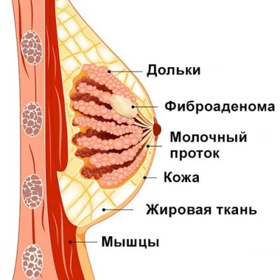 Кисты молочных желез