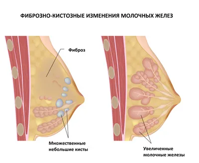 Нужен совет - фиброаденома, киста и прочие неизведанные ранее прелести |  Пикабу