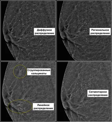 Мультимодальная диагностика молочной железы on Instagram: \"Всем доброго  времени суток, дорогие читатели! Сегодня расскажу о проблеме, которая  достаточно часто встречается у пациенток после операций, биопсий или травм молочной  железы. Кто знает о