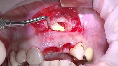 ᐈ Киста в десне зуба: последствия, чем опасна для человека