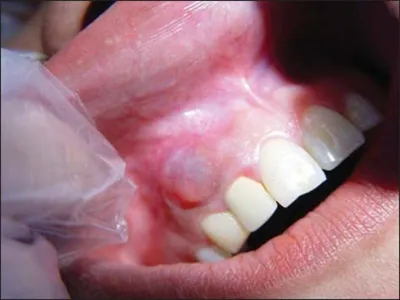 Киста зуба: симптомы, причины появления, чем опасна, методы лечения,  операция по удалению корневой радикулярной кисты в стоматологии