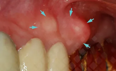 Киста после удаления зуба: кто виноват и как лечить заболевание | Dental Art