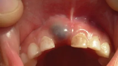 Что нужно знать о кисте зуба? Реальные фото | Стоматология Smile-at-Once |  Дзен