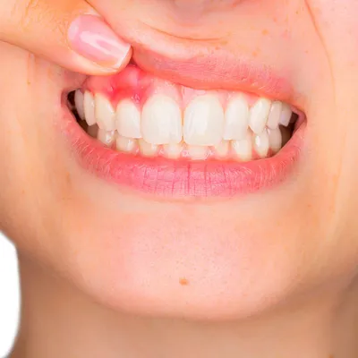 Удаление кисты зуба – показания, методы операции, можно ли вылечить без  удаления