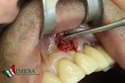 Как образуется киста зуба и какими методами её лечить